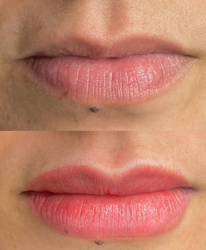 Resultado comparativo de micropigmentação labial